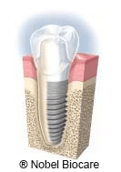 Reposicion de dientes mediante implantes