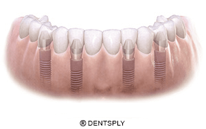 especialistas en implantes dentales en Barcelona