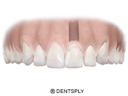 implante molar en mandíbula superior
