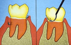 Raspado dental y alisado radicular
