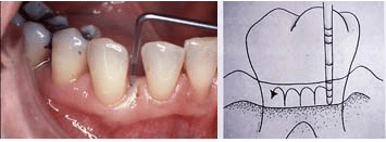 Problemes de genives sagnants