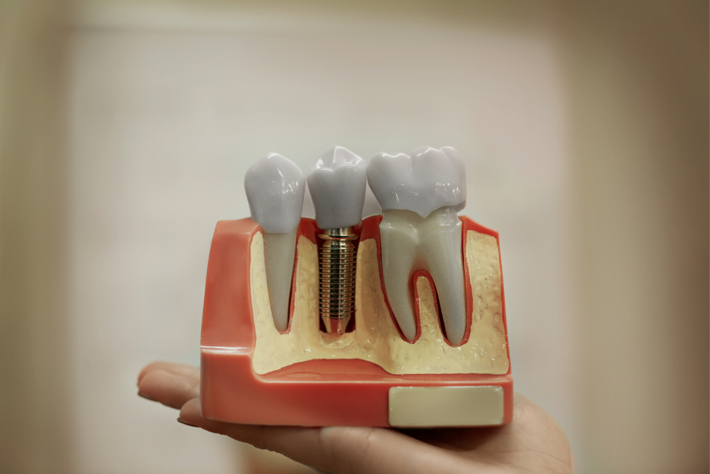 rejection-dental-implants-drvilar