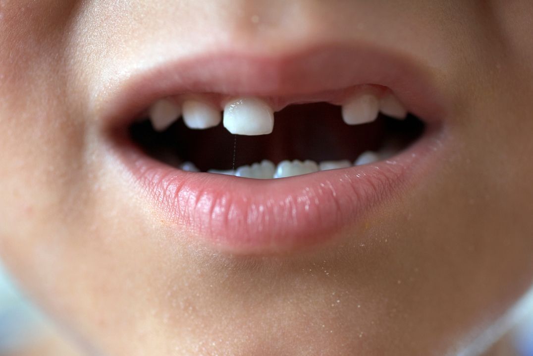 La importància de l'actuació primerenca en traumatismes dentals infantils