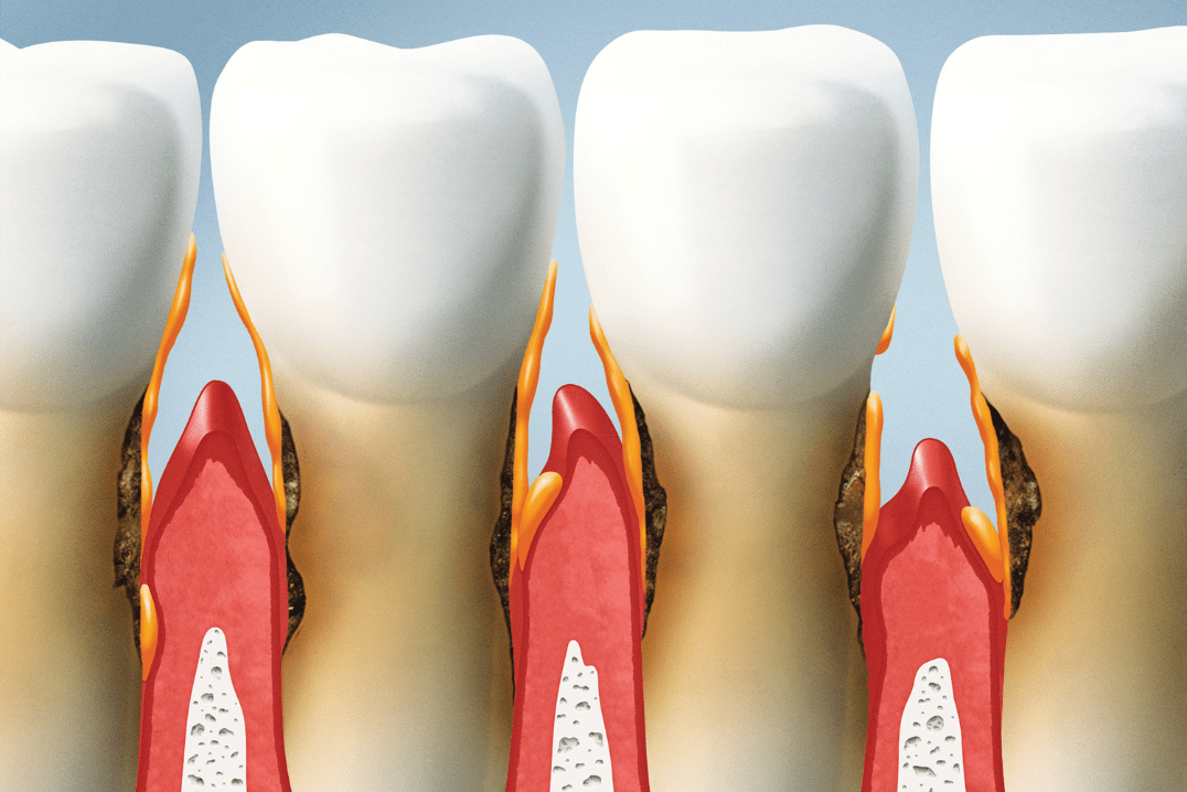 Recesiones en la encía